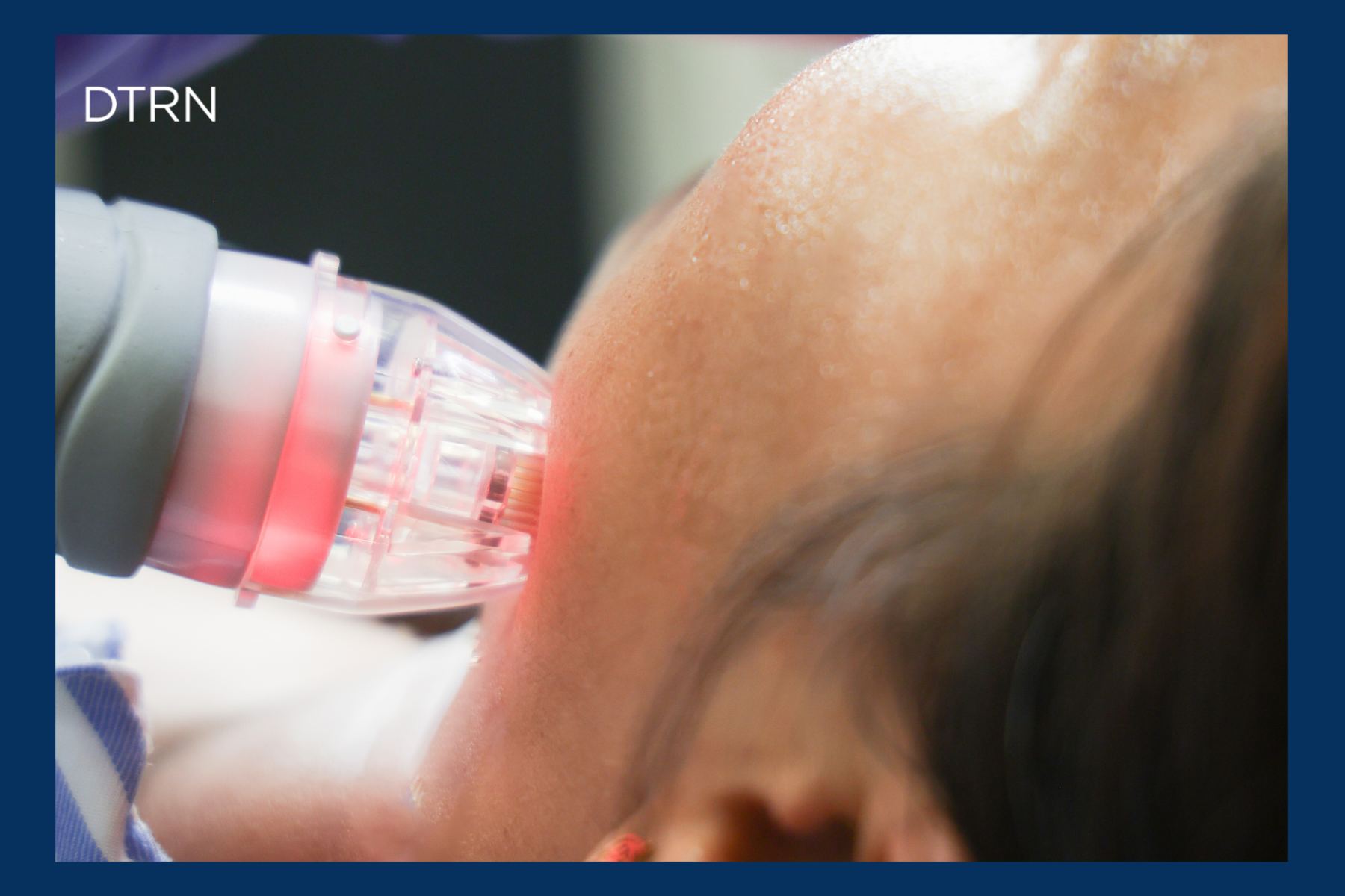 Melasma Treatments