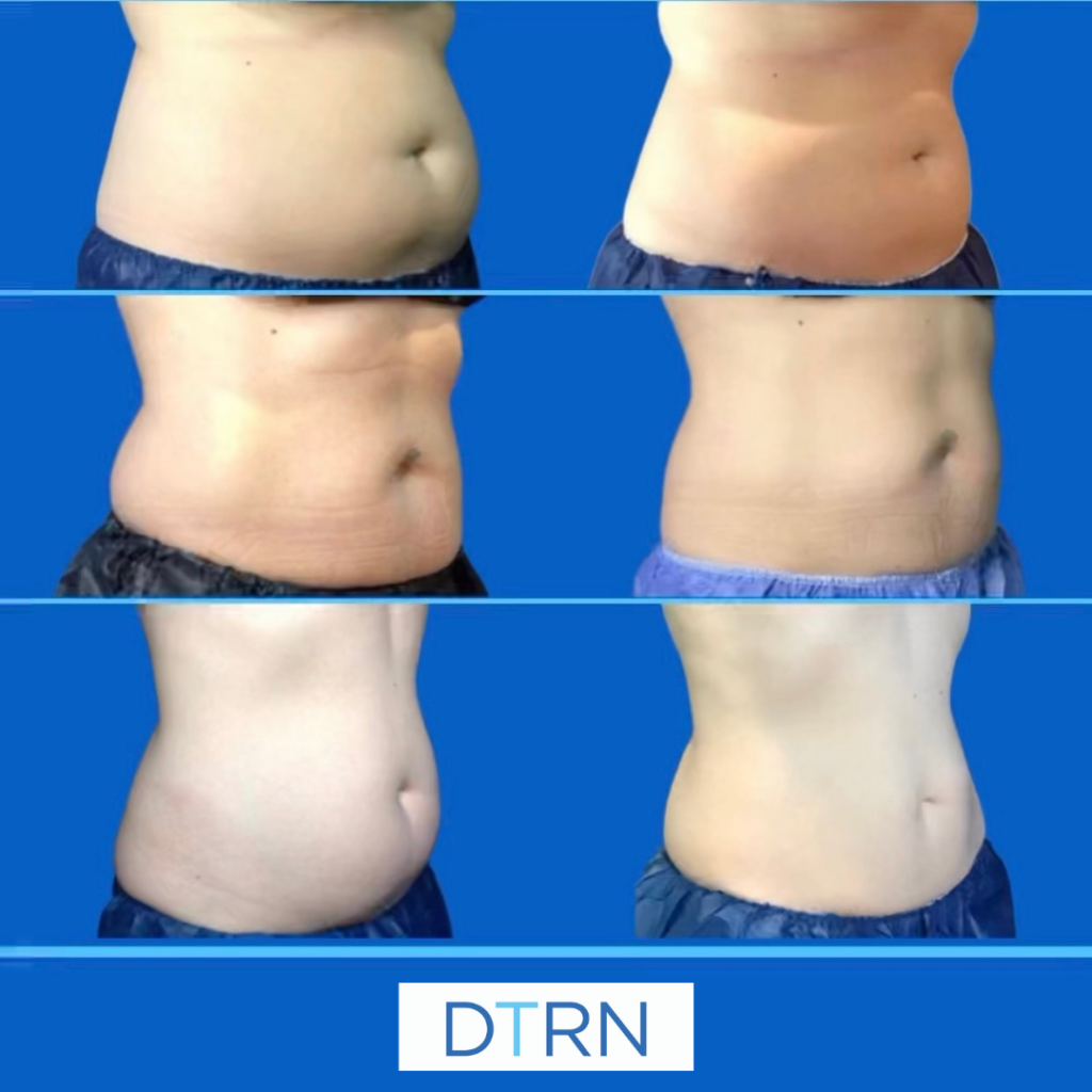 CoolSculpting Elite Before & After DermaTouch RN