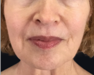 Dermal Fillers and Injectables Before and After Pictures Houston, TX