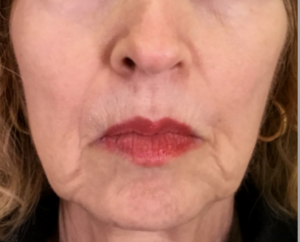 Dermal Fillers and Injectables Before and After Pictures Houston, TX