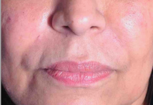 Dermal Fillers and Injectables Before and After Pictures Houston, TX