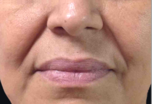 Dermal Fillers and Injectables Before and After Pictures Houston, TX