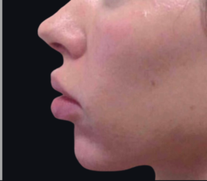 Dermal Fillers and Injectables Before and After Pictures Houston, TX