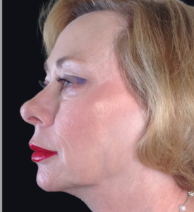 Dermal Fillers and Injectables Before and After Pictures Houston, TX