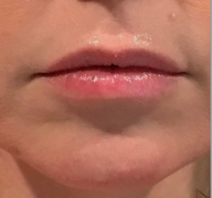 Dermal Fillers and Injectables Before and After Pictures Houston, TX