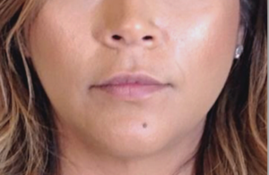 Dermal Fillers and Injectables Before and After Pictures Houston, TX