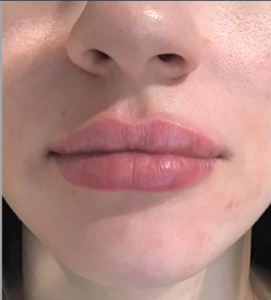 Dermal Fillers and Injectables Before and After Pictures Houston, TX