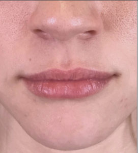 Dermal Fillers and Injectables Before and After Pictures Houston, TX