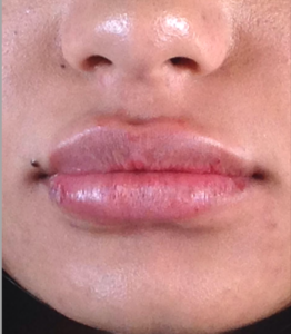 Dermal Fillers and Injectables Before and After Pictures Houston, TX