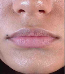 Dermal Fillers and Injectables Before and After Pictures Houston, TX