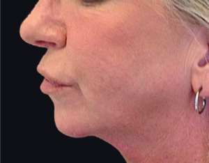 Dermal Fillers and Injectables Before and After Pictures Houston, TX