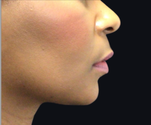 Dermal Fillers and Injectables Before and After Pictures Houston, TX