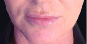 Dermal Fillers and Injectables Before and After Pictures Houston, TX