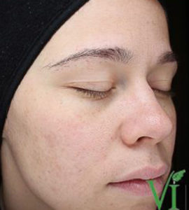 Chemical Peels Before and After Pictures Houston, TX