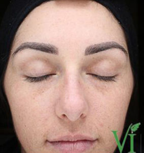 Chemical Peels Before and After Pictures Houston, TX