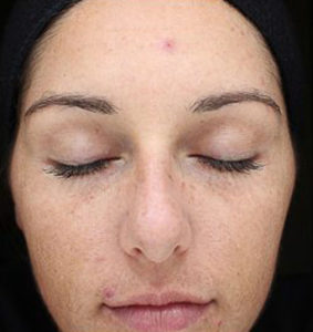 Chemical Peels Before and After Pictures Houston, TX