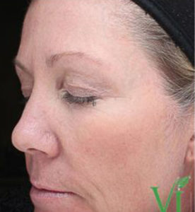 Chemical Peels Before and After Pictures Houston, TX