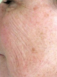 Chemical Peels Before and After Pictures Houston, TX