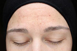 Chemical Peels Before and After Pictures Houston, TX