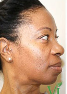 Chemical Peels Before and After Pictures Houston, TX