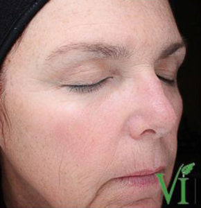 Chemical Peels Before and After Pictures Houston, TX