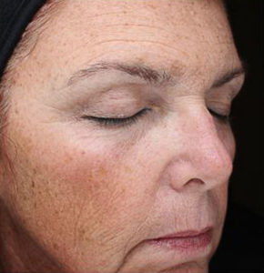 Chemical Peels Before and After Pictures Houston, TX