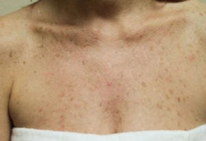 Chemical Peels Before and After Pictures Houston, TX