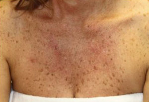 Chemical Peels Before and After Pictures Houston, TX