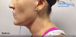 Kybella® Before and After Pictures Houston, TX