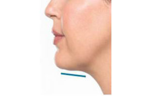 Kybella® Before and After Pictures Houston, TX