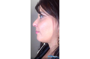 Kybella® Before and After Pictures Houston, TX