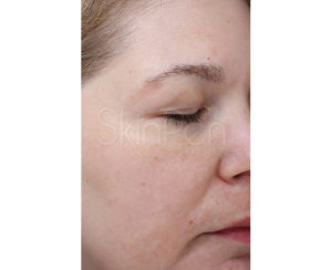 Microneedling Before and After Pictures Houston, TX