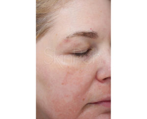 Microneedling Before and After Pictures Houston, TX