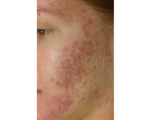 Microneedling Before and After Pictures Houston, TX