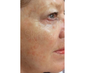 Microneedling Before and After Pictures Houston, TX