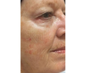 Microneedling Before and After Pictures Houston, TX