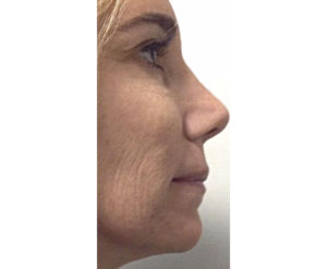 Ultherapy® Before and After Pictures Houston, TX