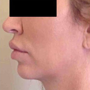 Ultherapy® Before and After Pictures Houston, TX