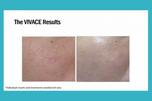 Microneedling Radiofrequency in Houston, TX