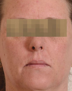 Laser Resurfacing Before and After Pictures Houston, TX