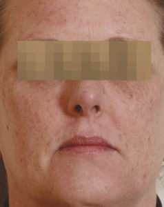 Laser Resurfacing Before and After Pictures Houston, TX