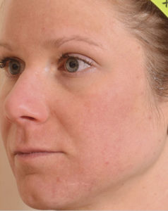 Laser Resurfacing Before and After Pictures Houston, TX