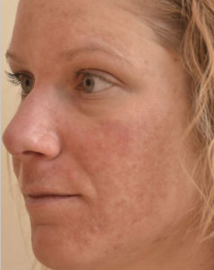 Laser Resurfacing Before and After Pictures Houston, TX