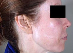 Laser Resurfacing Before and After Pictures Houston, TX