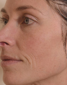 Laser Resurfacing Before and After Pictures Houston, TX