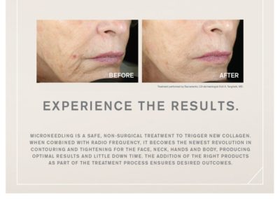 Microneedling Radiofrequency Before and After Pictures Houston, TX
