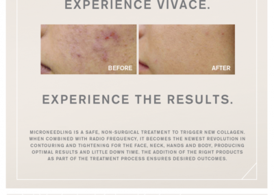 Microneedling Radiofrequency Before and After Pictures Houston, TX