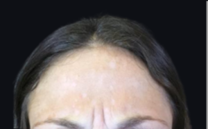 Botox® or Dysport® Before and After Pictures Houston, TX