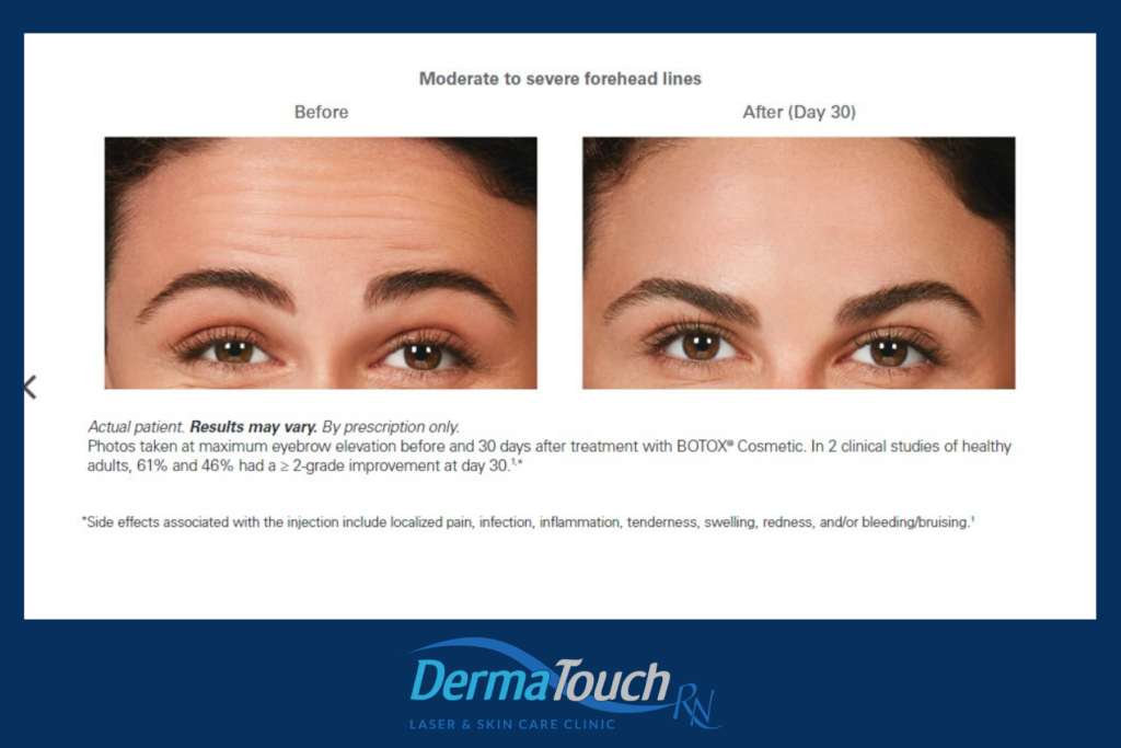 Botox Forehead lines Before & After DermaTouch RN