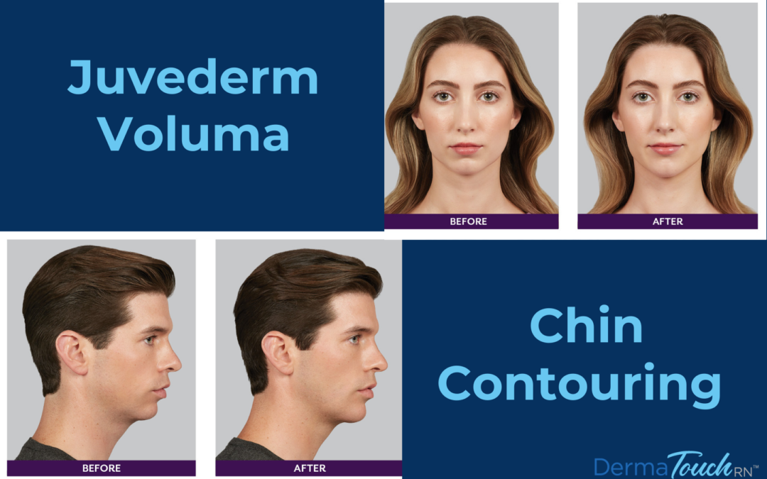 Facial Enhancement with Chin Contouring Dermal Filler